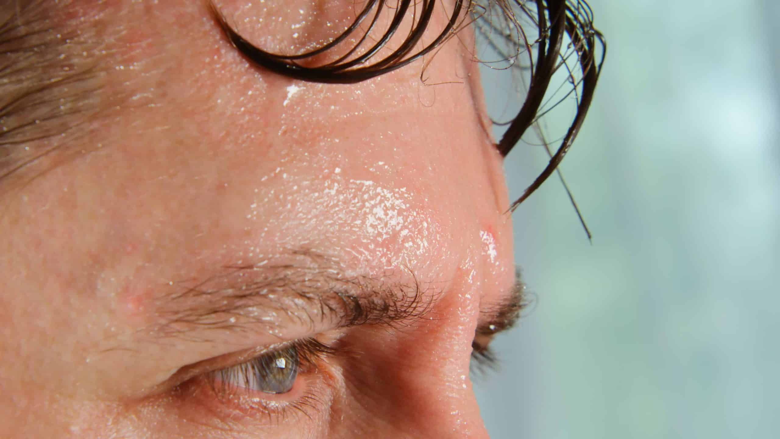 Exploring Natural Remedies For Excessive Sweating